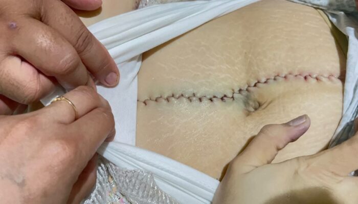 Keluarga Bantah Dugaan Bunuh Diri Winda Gowasa, Soroti Lebam hingga Proses Autopsi